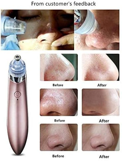 Beauty Find Back Beauty Facial Cleanser Blackhead Vacuum QL-605